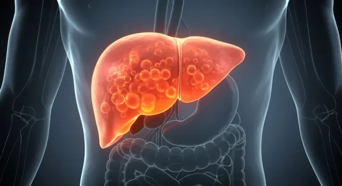 Understanding Fatty Liver