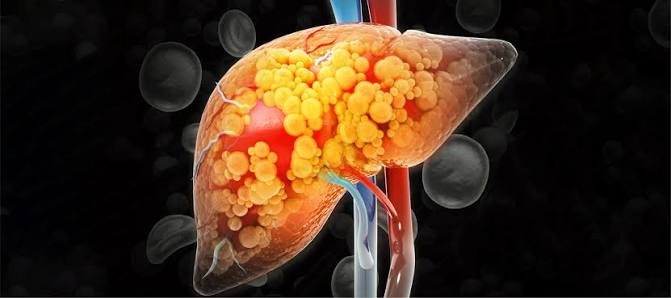 Reversing Fatty Liver
